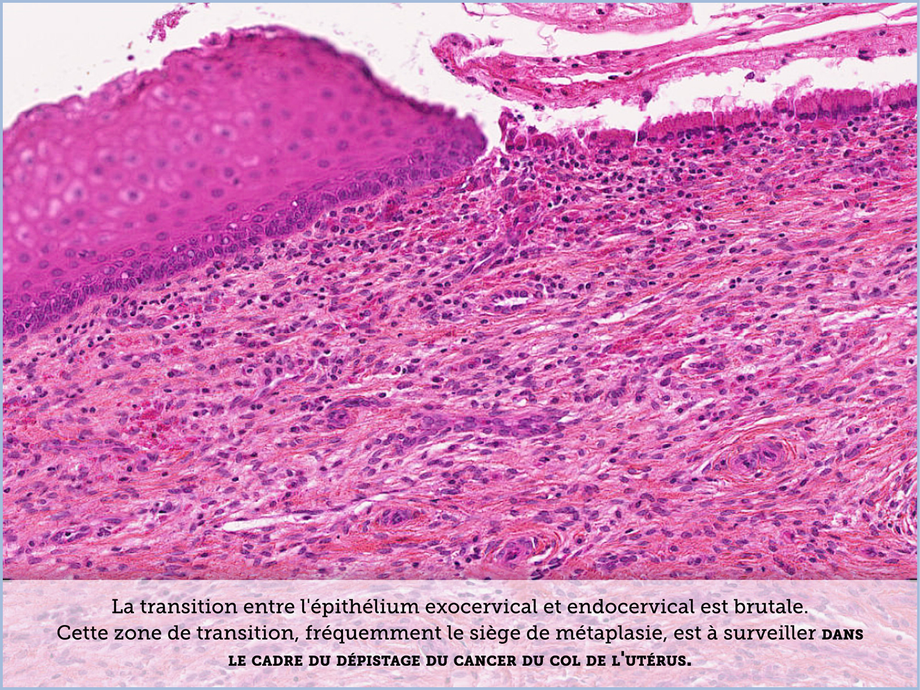 FICHE 2 TUMEUR WARTHIN ECRAN B
