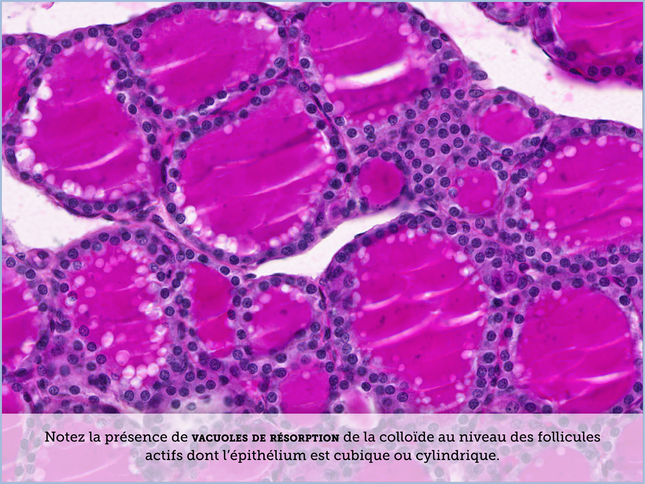 FICHE 2 TUMEUR WARTHIN ECRAN A