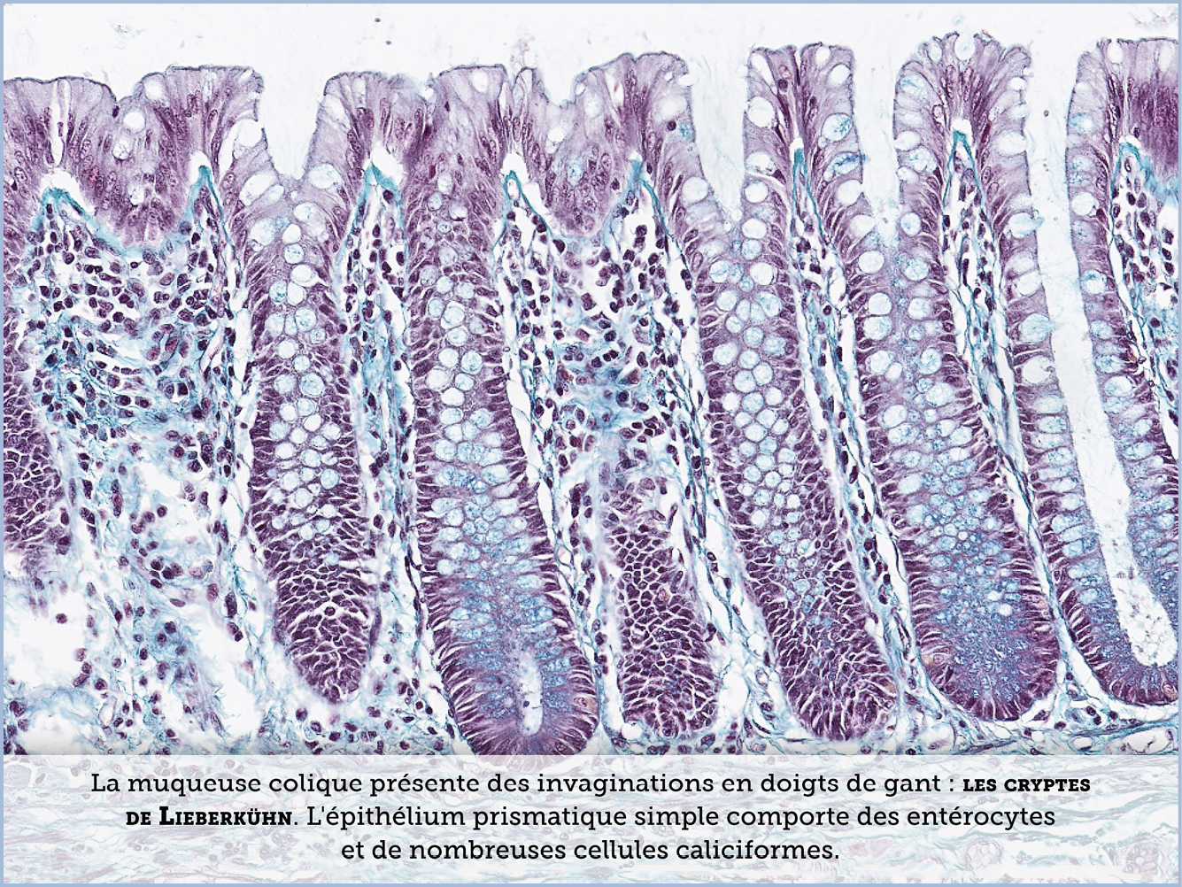 FICHE 2 TUMEUR WARTHIN VIDEO
