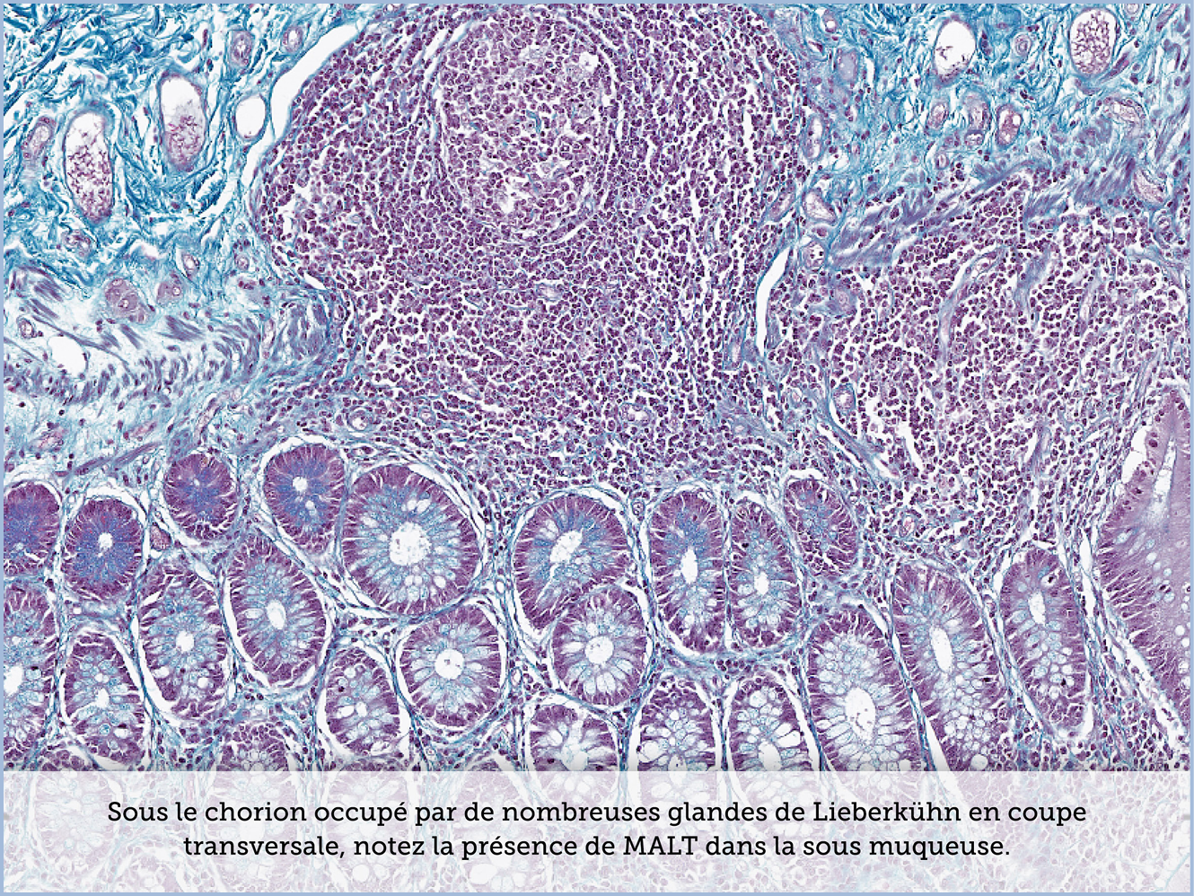 FICHE 2 TUMEUR WARTHIN ECRAN C