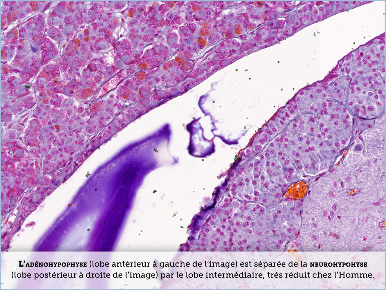 FICHE 2 TUMEUR WARTHIN VIDEO
