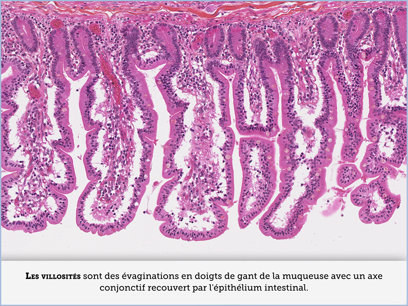 FICHE 2 TUMEUR WARTHIN ECRAN C
