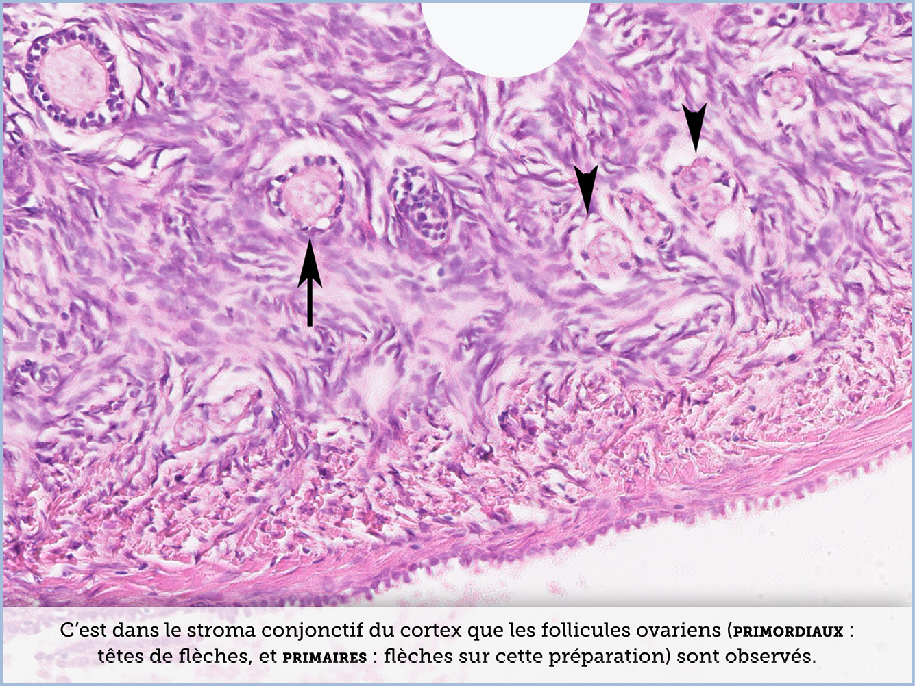 FICHE 2 TUMEUR WARTHIN VIDEO