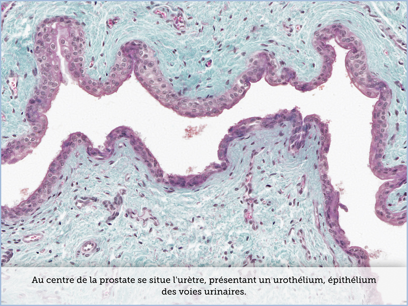 FICHE 2 TUMEUR WARTHIN ECRAN A