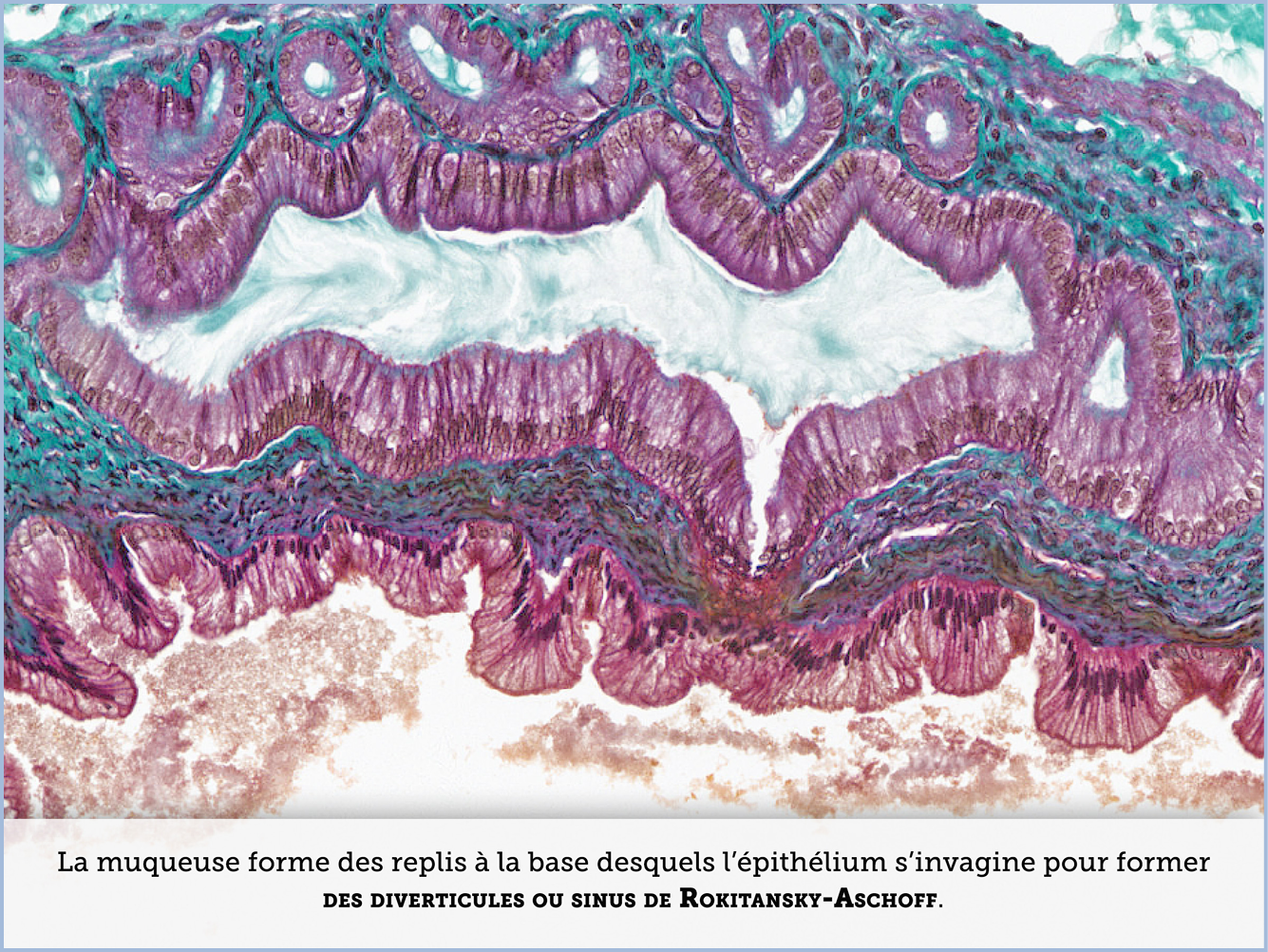 FICHE 2 TUMEUR WARTHIN VIDEO