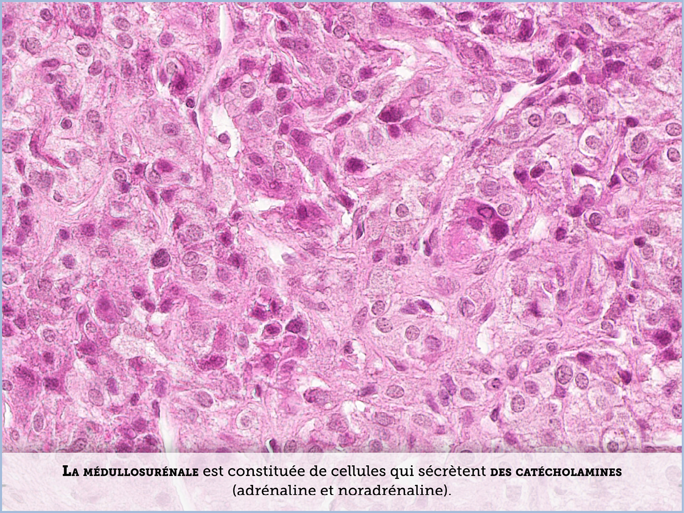 FICHE 2 TUMEUR WARTHIN ECRAN A