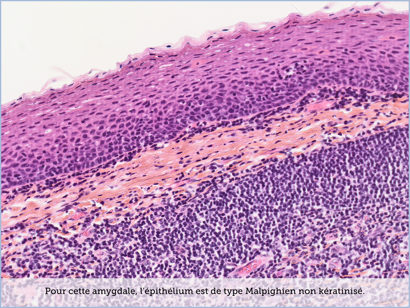 FICHE 2 TUMEUR WARTHIN VIDEO