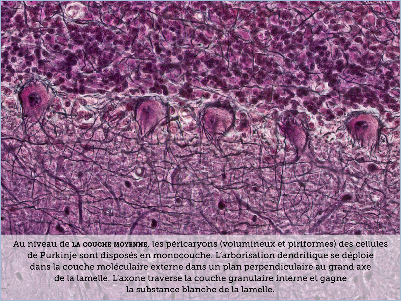FICHE 2 TUMEUR WARTHIN ECRAN C