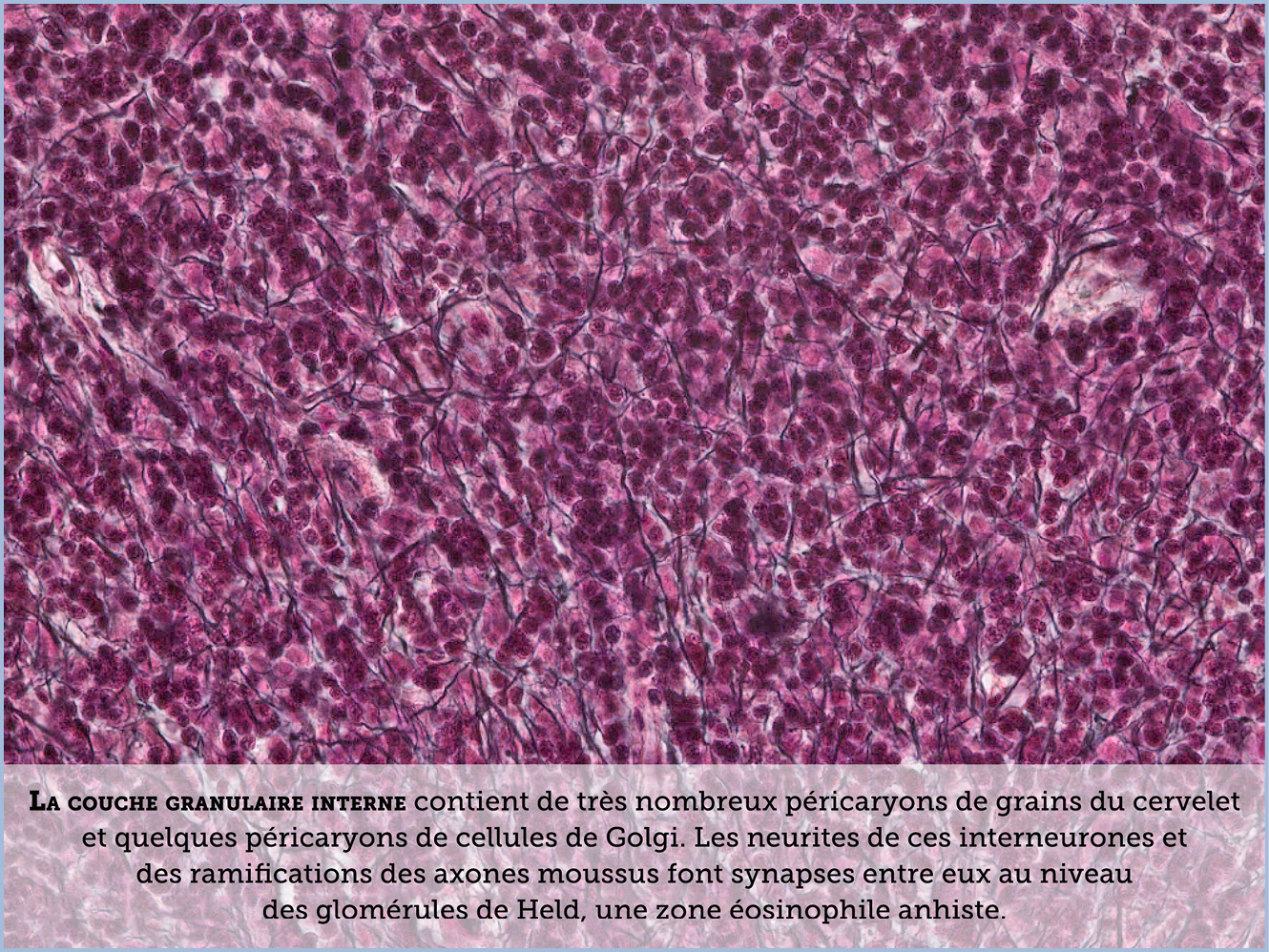 FICHE 2 TUMEUR WARTHIN ECRAN B