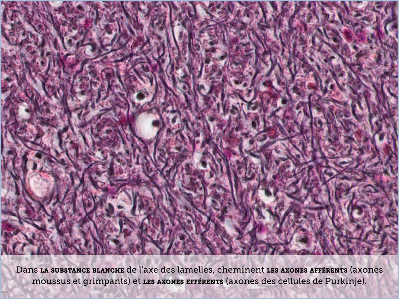 FICHE 2 TUMEUR WARTHIN ECRAN A