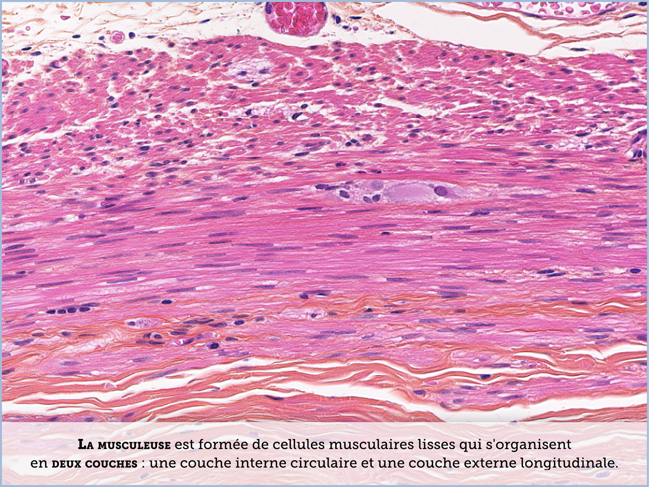 FICHE 2 TUMEUR WARTHIN ECRAN B