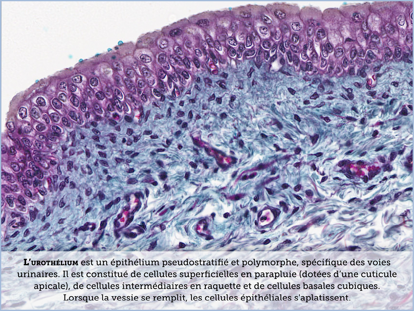 FICHE 2 TUMEUR WARTHIN ECRAN C