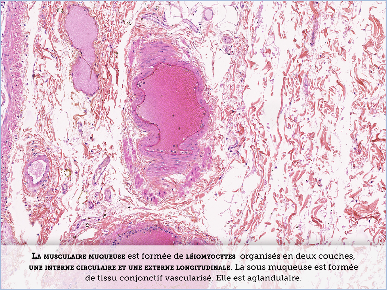 FICHE 2 TUMEUR WARTHIN ECRAN B