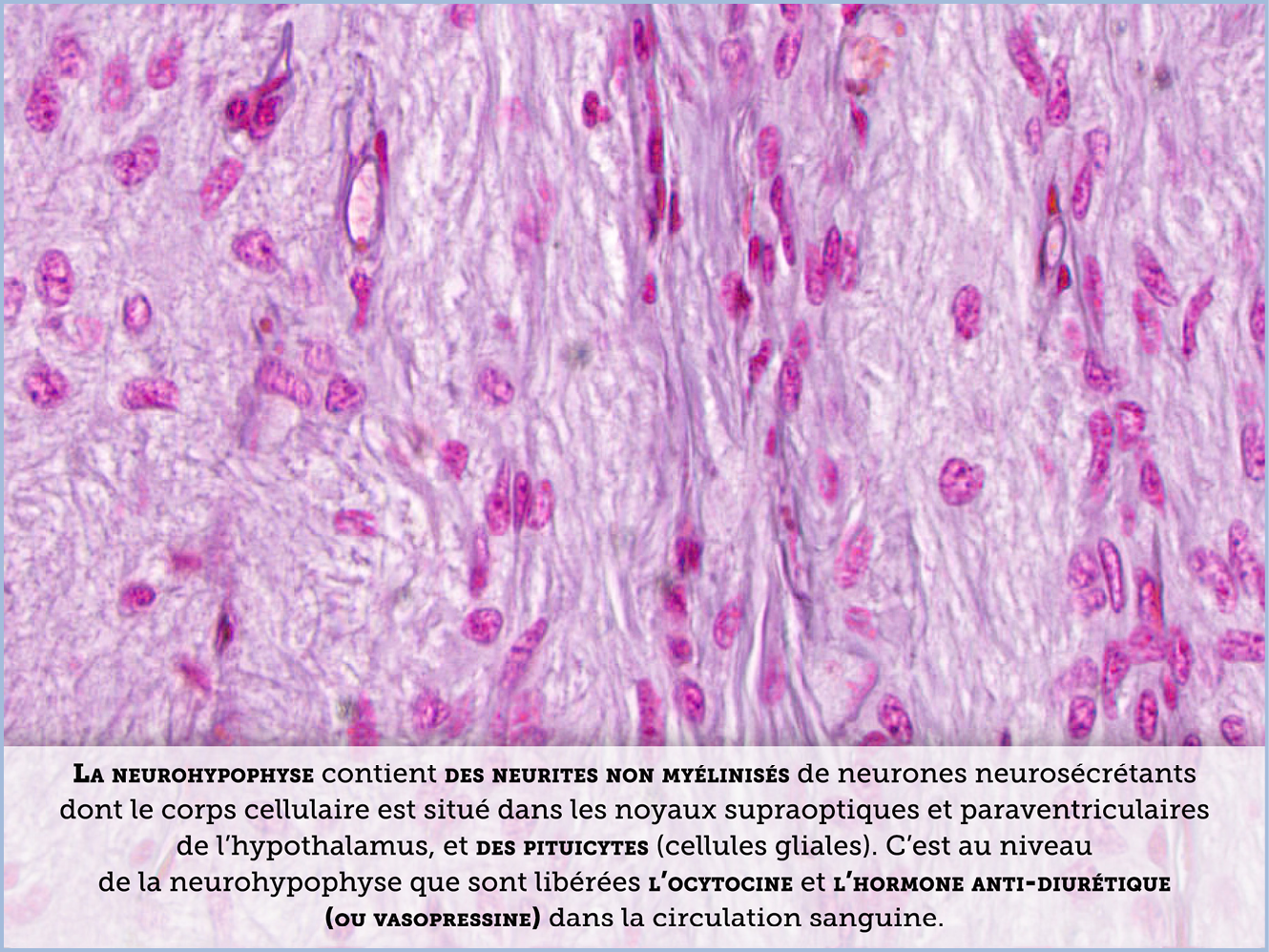 FICHE 2 TUMEUR WARTHIN ECRAN A