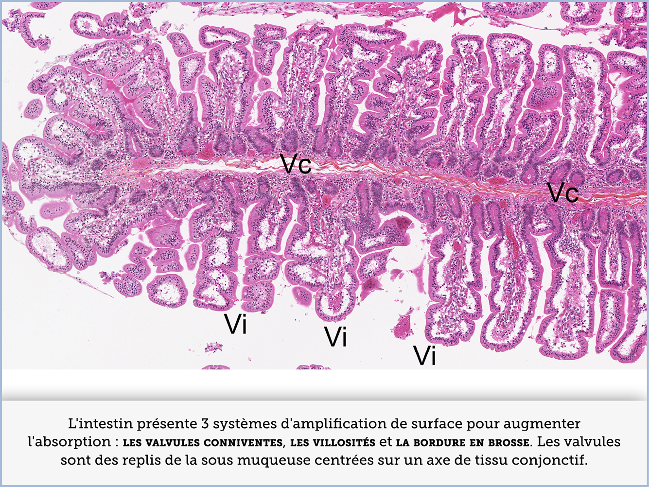 FICHE 2 TUMEUR WARTHIN VIDEO