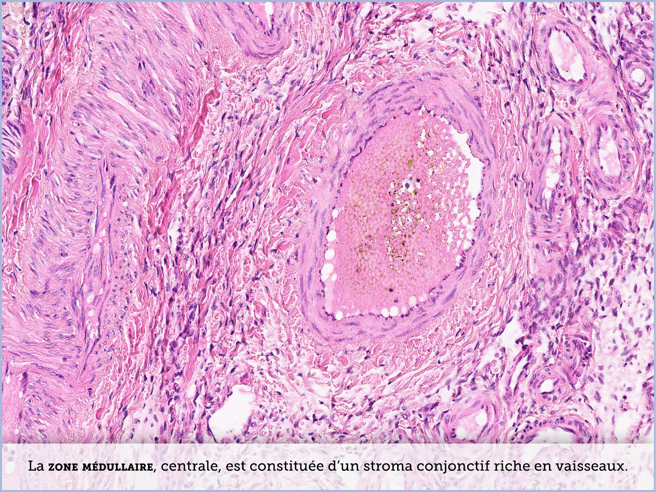 FICHE 2 TUMEUR WARTHIN ECRAN A