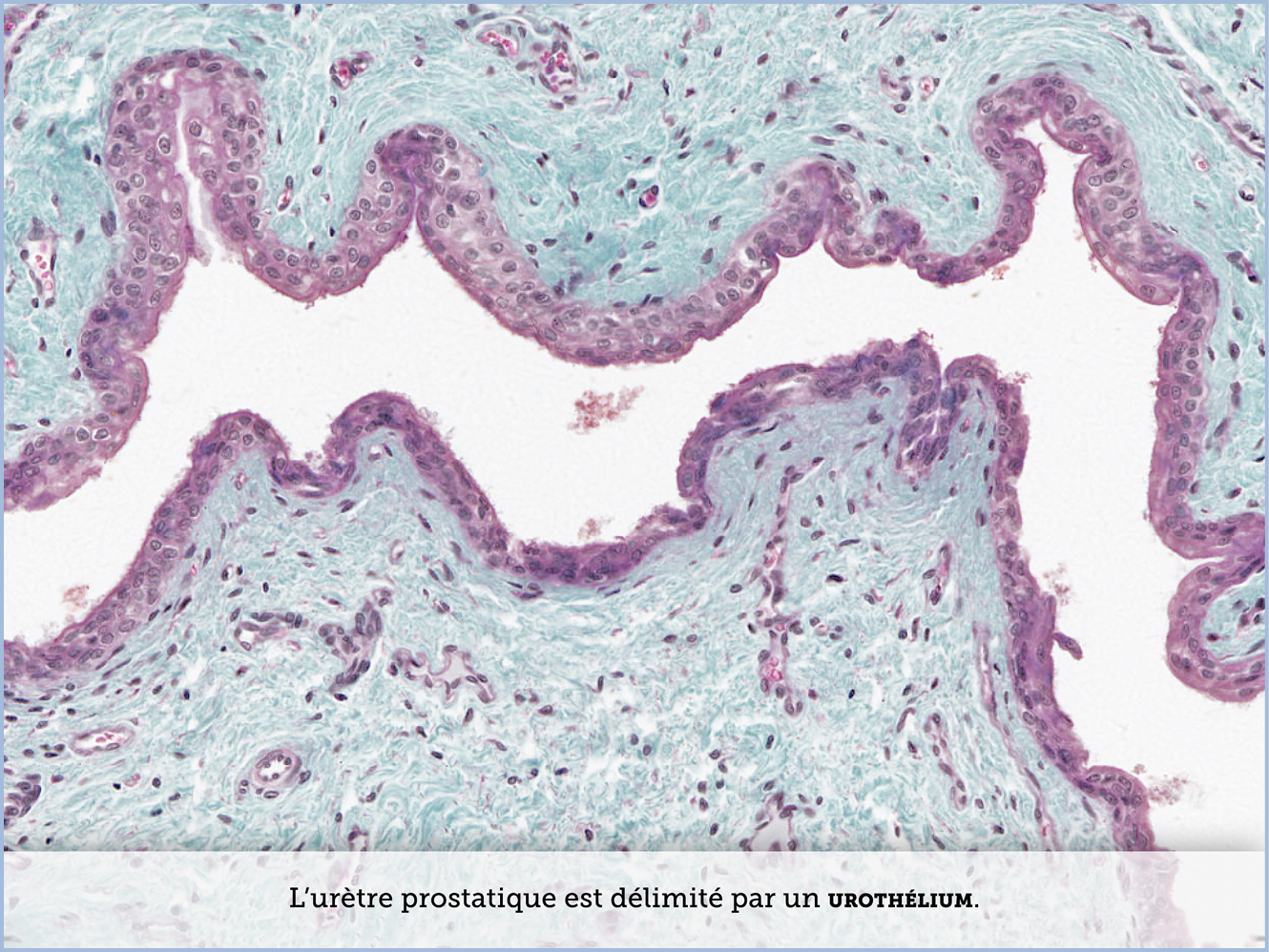 FICHE 2 TUMEUR WARTHIN ECRAN B