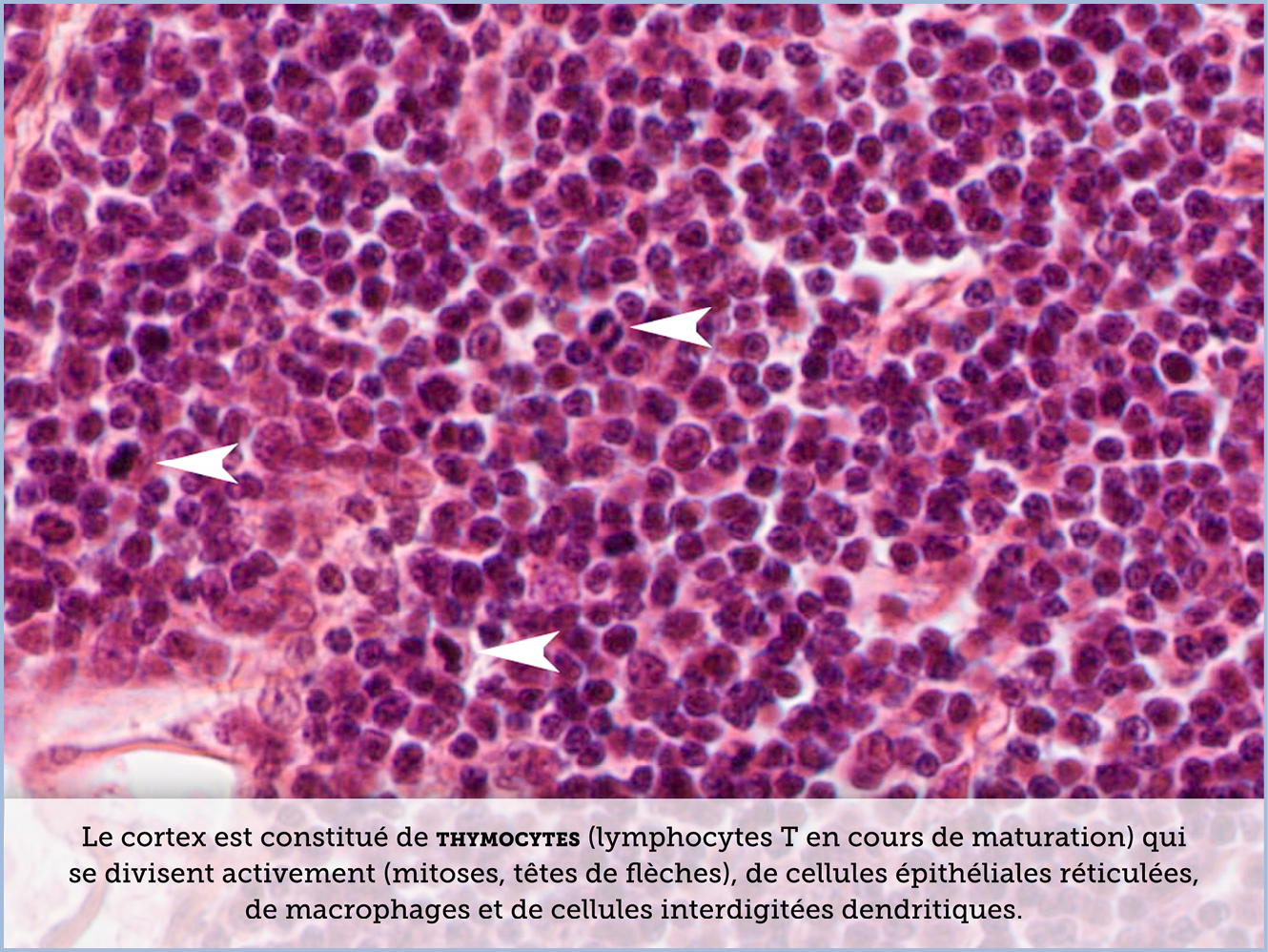FICHE 2 TUMEUR WARTHIN ECRAN B