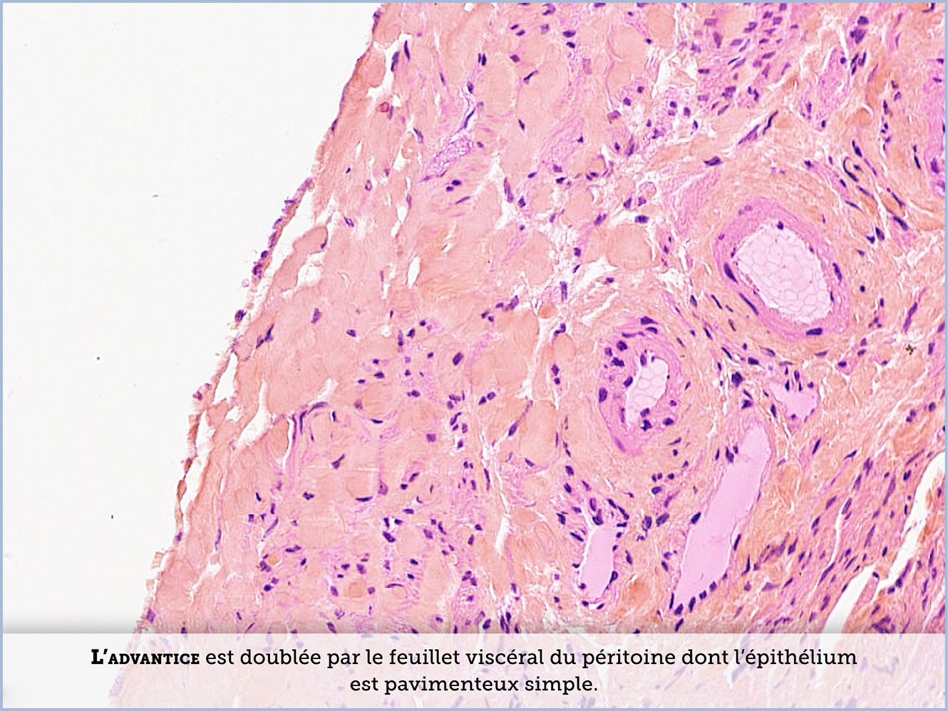 FICHE 2 TUMEUR WARTHIN ECRAN A