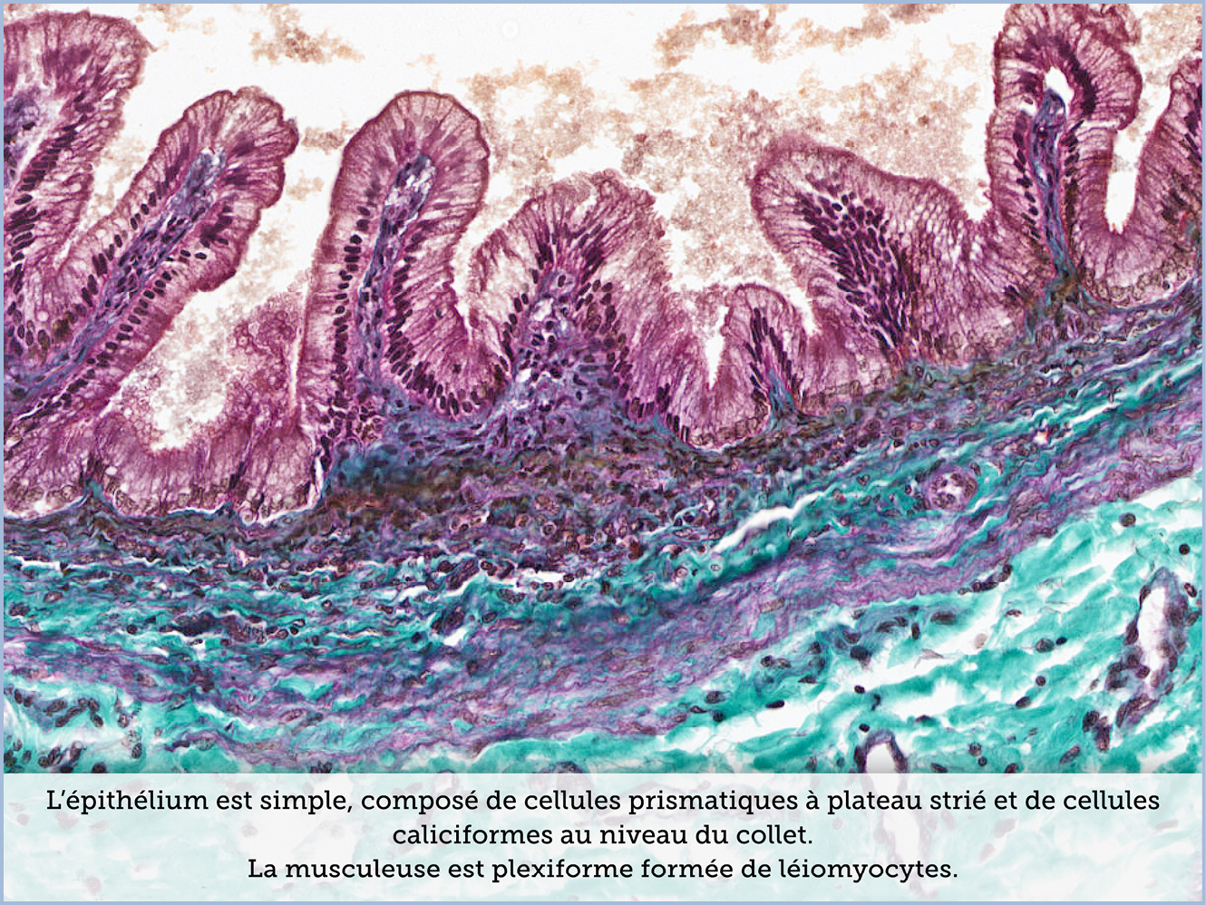 FICHE 2 TUMEUR WARTHIN ECRAN C