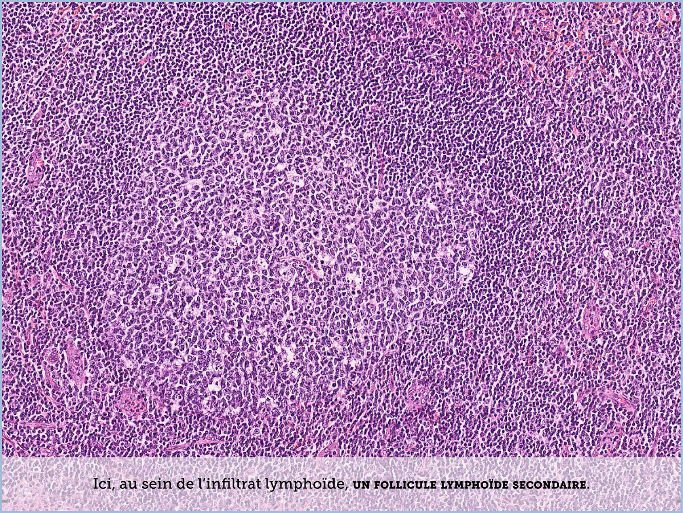 FICHE 2 TUMEUR WARTHIN ECRAN B