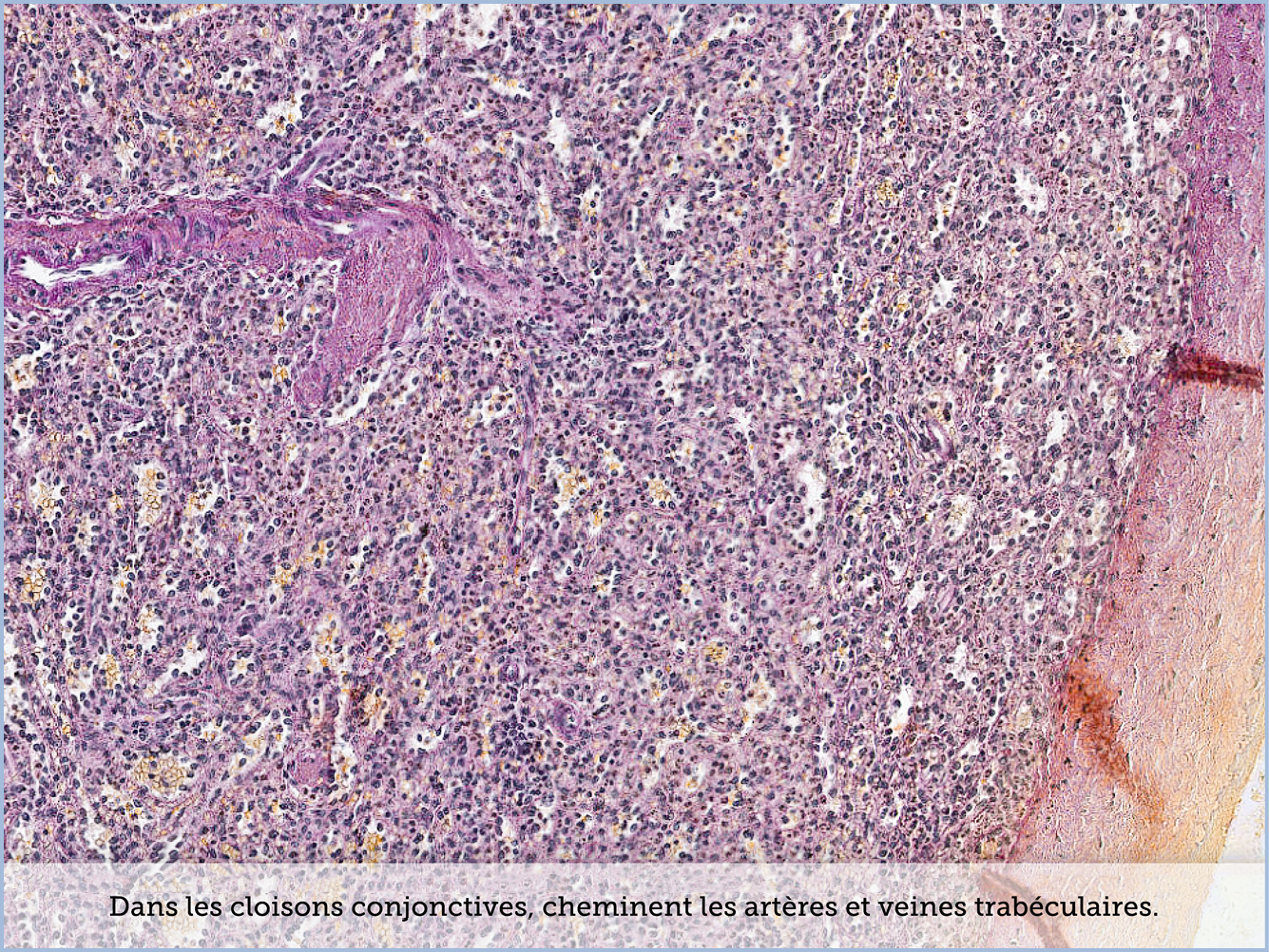 FICHE 2 TUMEUR WARTHIN VIDEO