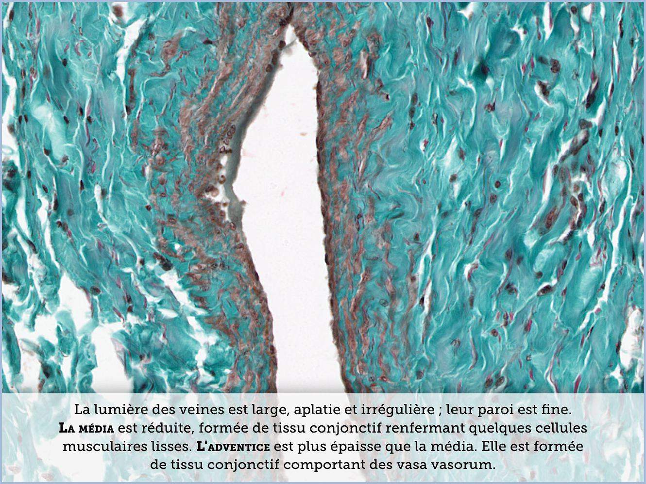 FICHE 2 TUMEUR WARTHIN ECRAN A