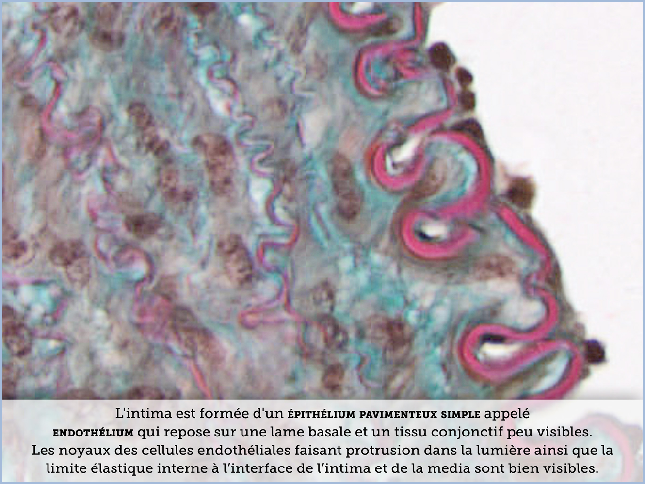 FICHE 2 TUMEUR WARTHIN ECRAN C