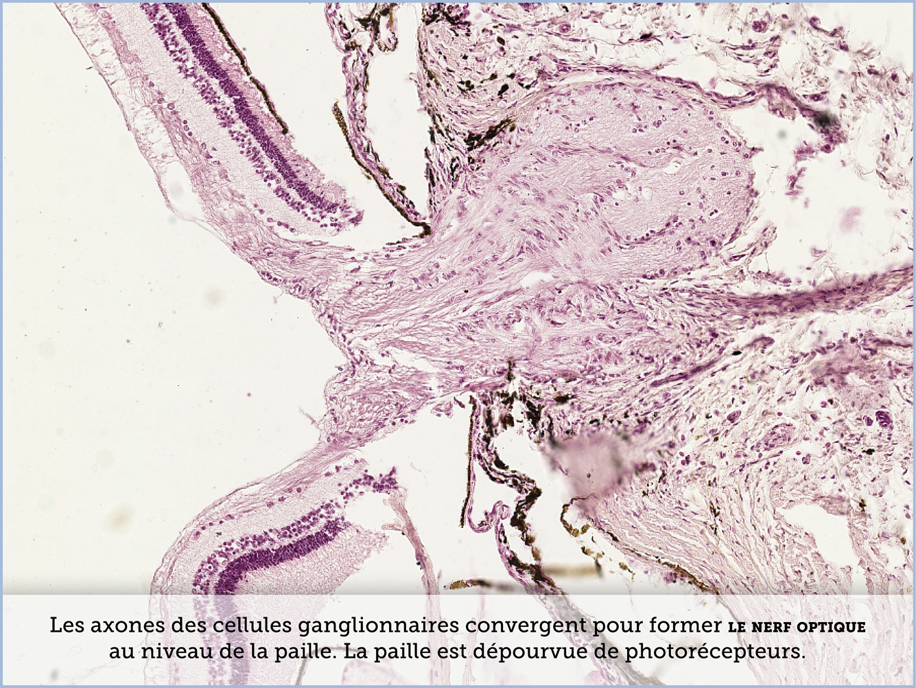 FICHE 2 TUMEUR WARTHIN VIDEO