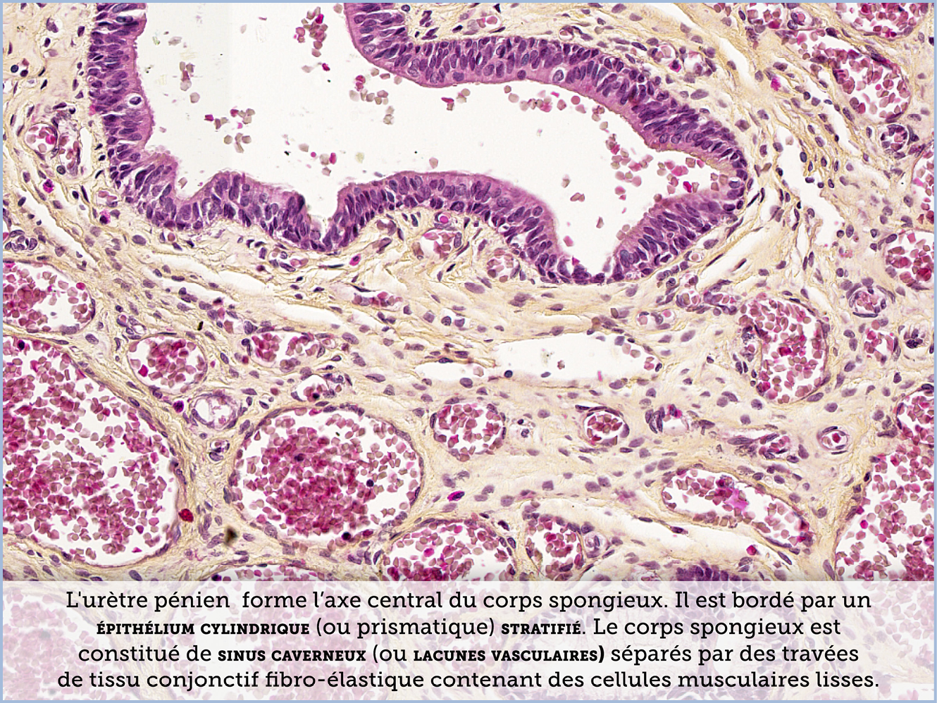 FICHE 2 TUMEUR WARTHIN ECRAN C
