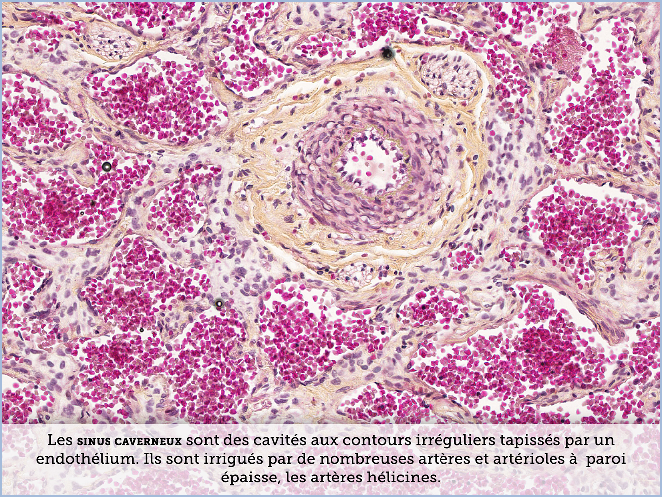 FICHE 2 TUMEUR WARTHIN ECRAN A