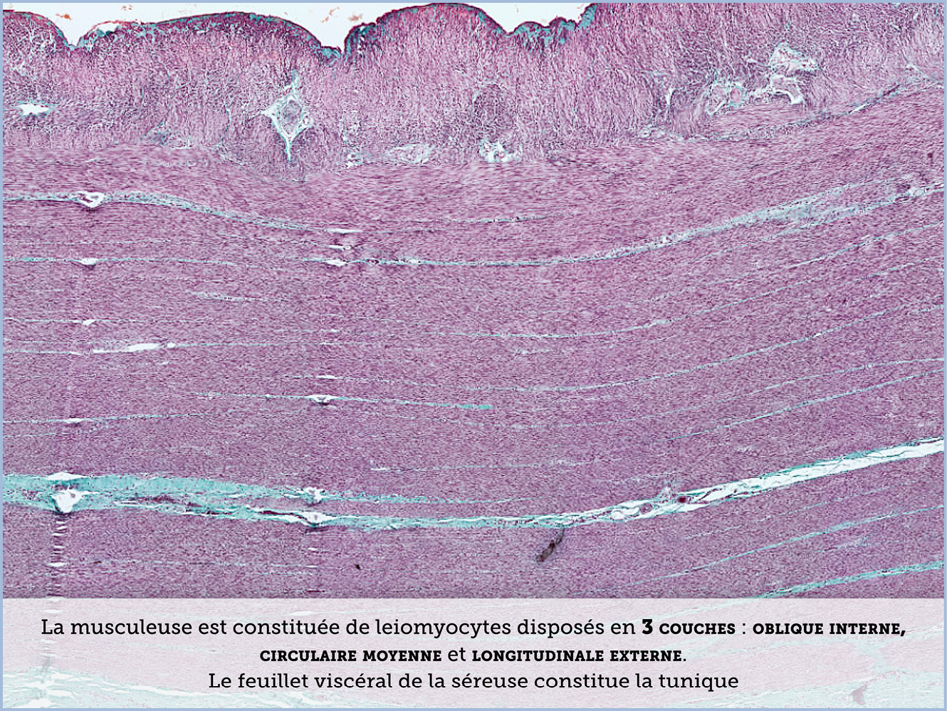 FICHE 2 TUMEUR WARTHIN ECRAN A
