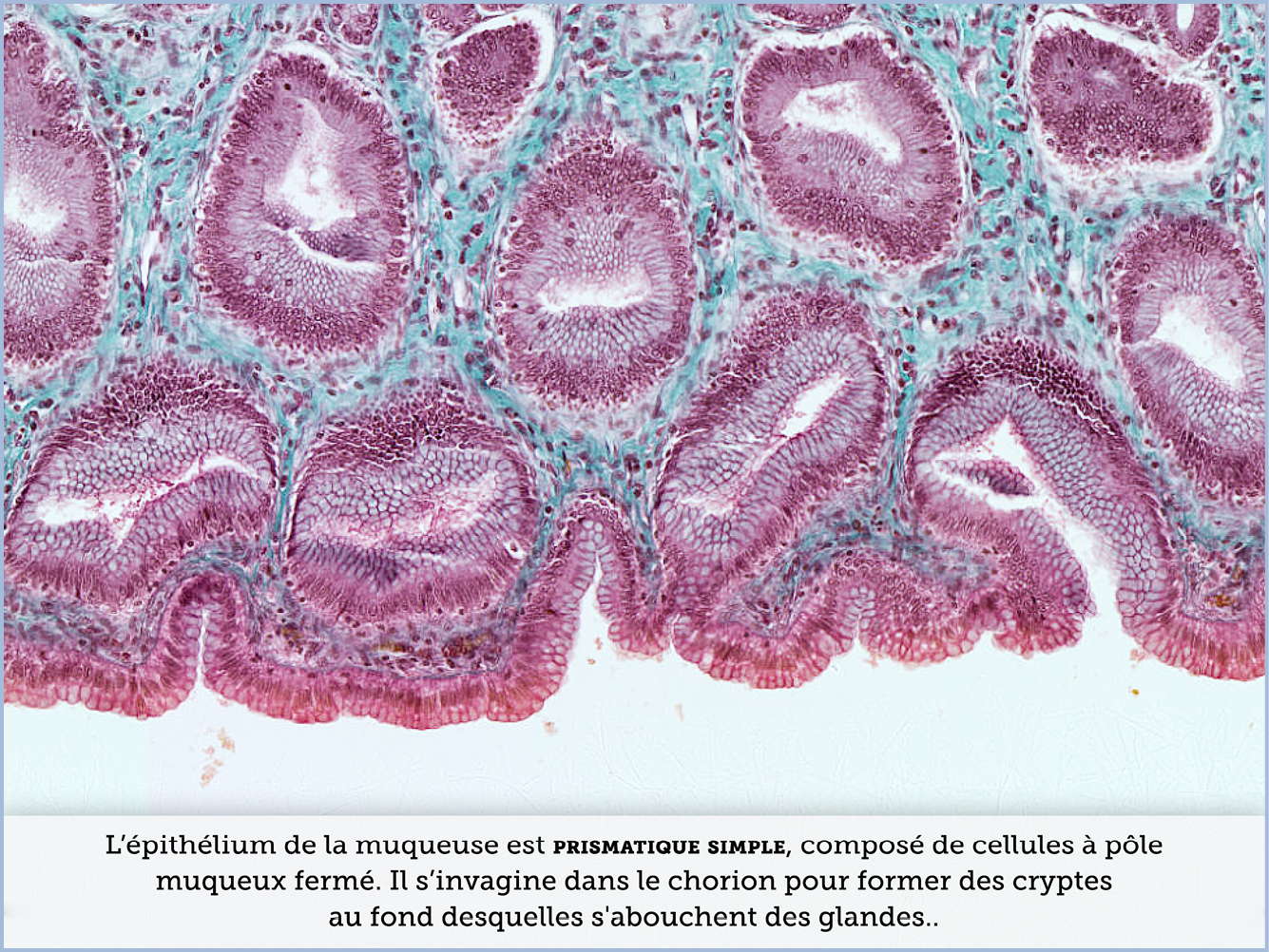 FICHE 2 TUMEUR WARTHIN VIDEO