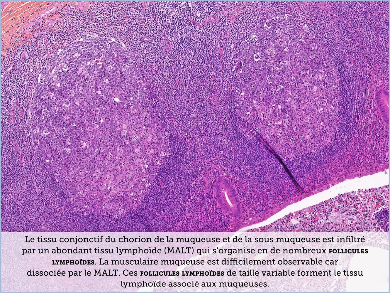 FICHE 2 TUMEUR WARTHIN ECRAN C